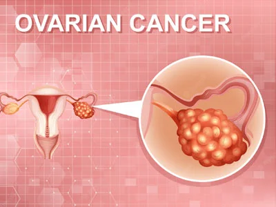 Case 6: Breast cancer in mother, ovarian cancer in maternal aunt, am I at risk too?